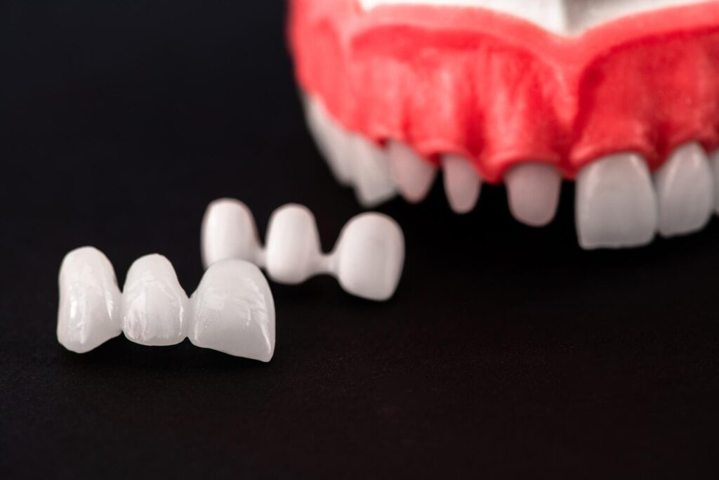 Teeth implant crown installation process parts isolated black background medically accurate 3d model 1078540 9113